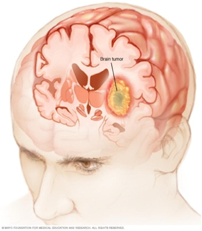  Brain tumor detection